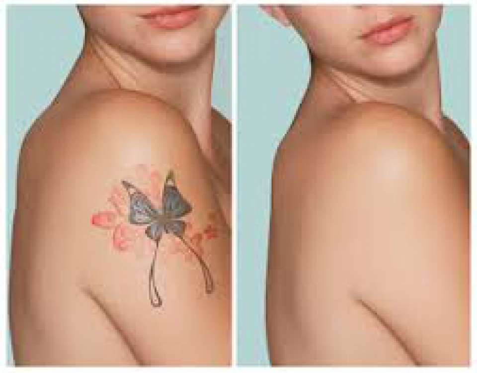 Eliminacion y borrado de tatuajes
